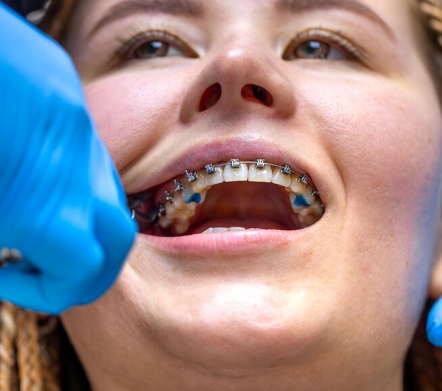 Orthodontic Overbite Correction Braces