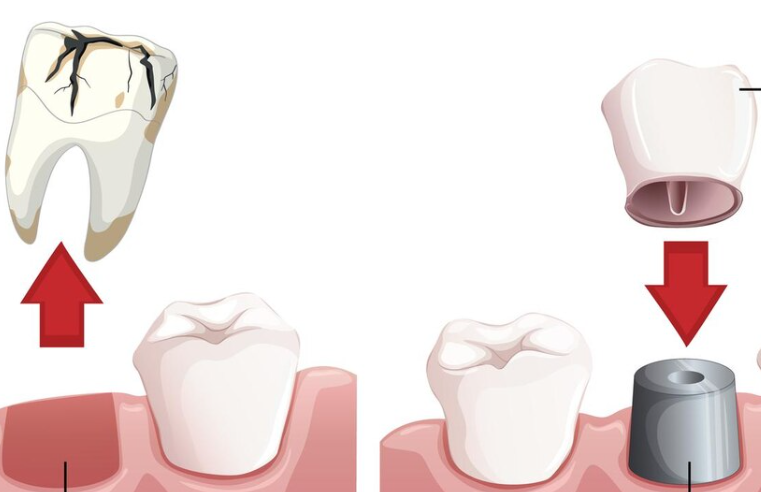 Bone Graft Assisted All-on-6 Implants