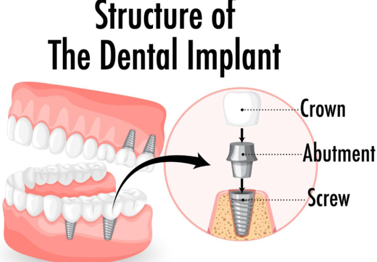 Pterygoid Implants