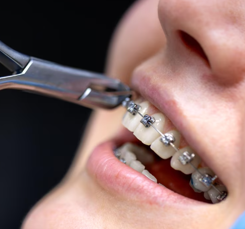 Quick Fix Metal Braces