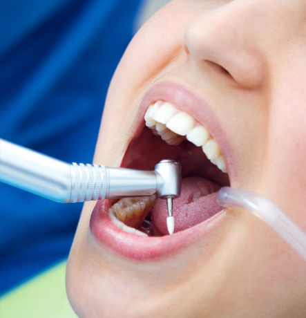 Micro-Etch Sealant Bonding