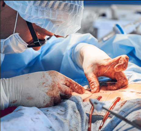 Single-Incision Laparoscopic Hysterectomy