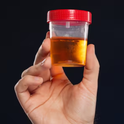 Urinalysis for UTI Detection