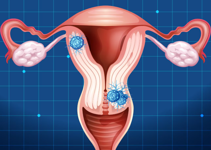 Vaginal Uterus Removal with Advanced Suturing Technique
