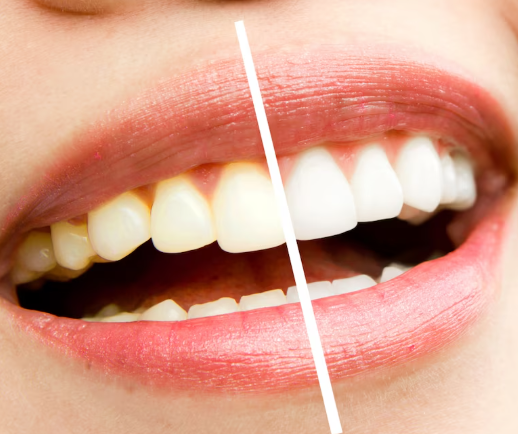 Cosmetic Whitening Polishing