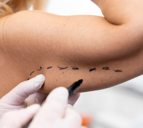 BodyLine Arm Lipolysis Injection