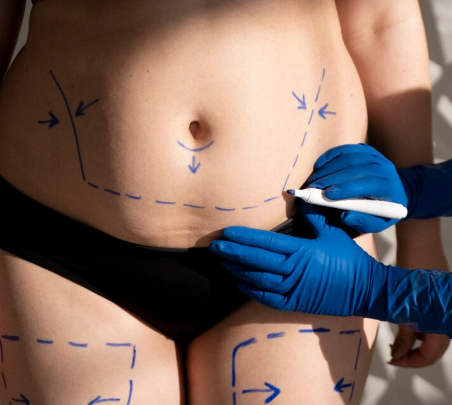 CoolSculpting Cellulite Contouring Treatment