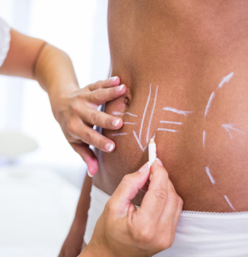 EMSculpt ReShape Body Contouring Therapy