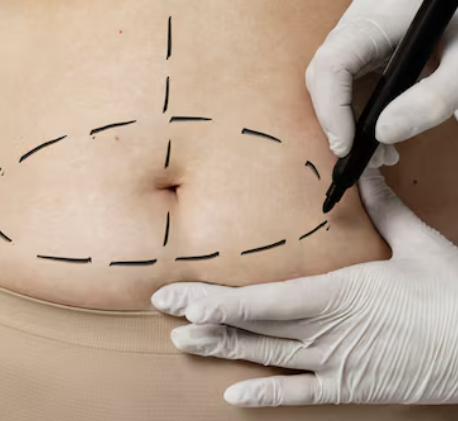 Micro Lipolysis Fat Dissolving Injection