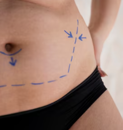 ReShape RF Fat Reduction Program